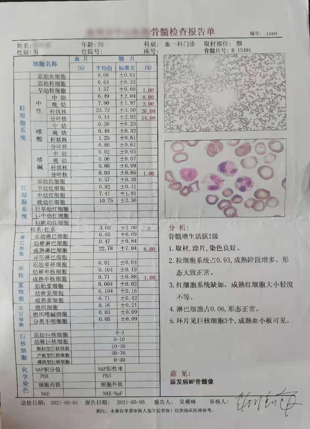 大咖谈病例｜景红梅教授点评-原发性骨髓纤维化（PMF）诊疗方法之病例解析