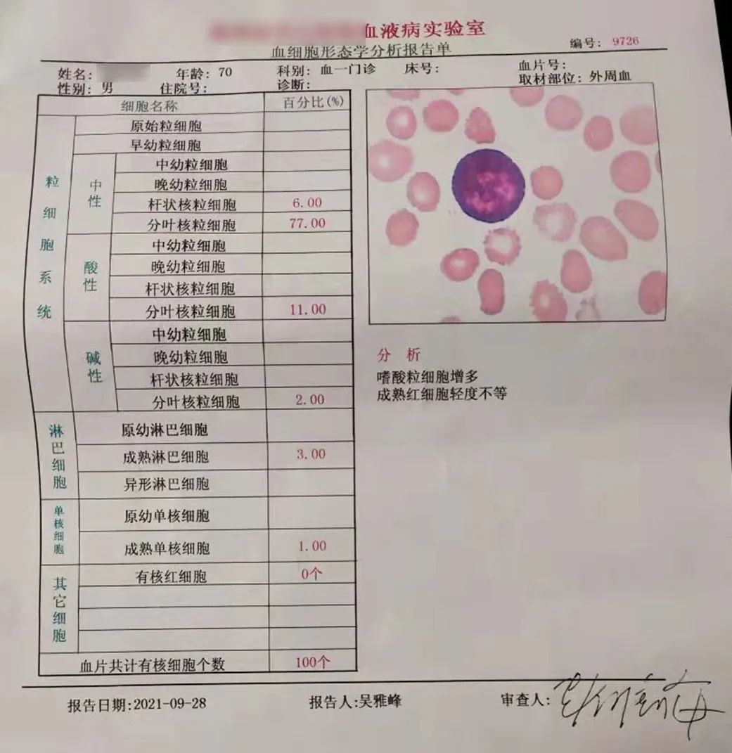 大咖谈病例｜景红梅教授点评-原发性骨髓纤维化（PMF）诊疗方法之病例解析