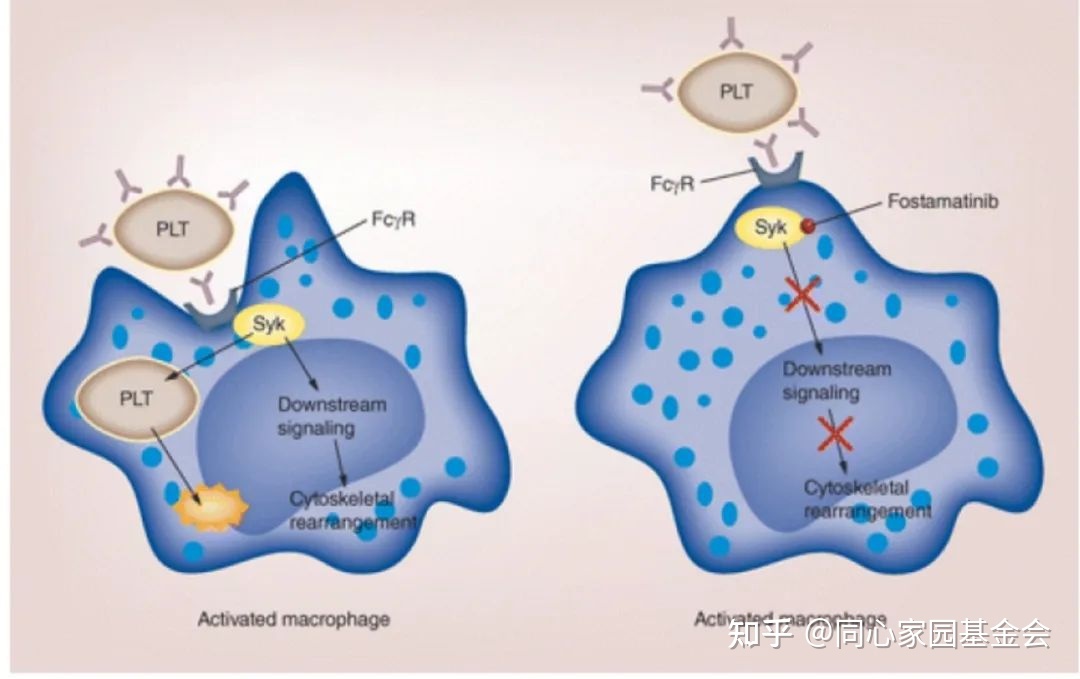 专家讲座 | ITP患者必读，周泽平教授带您解读治疗全方案