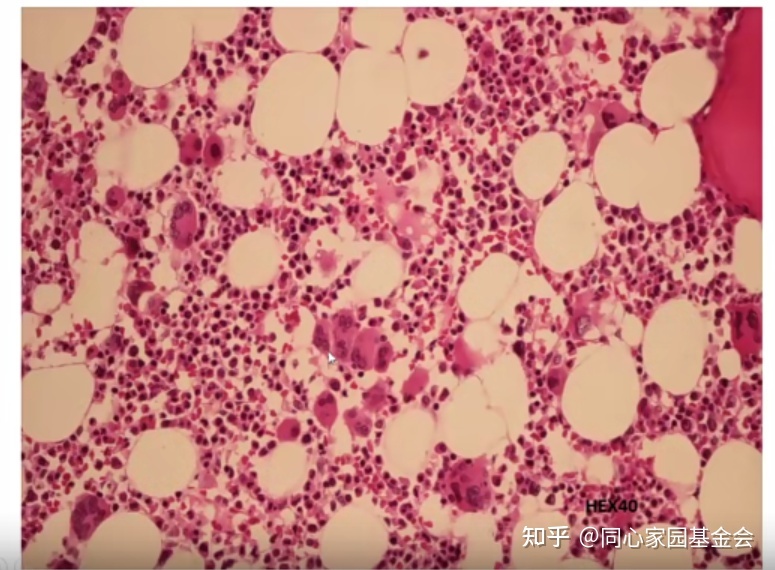 专家讲座｜张培红教授：骨髓增殖性肿瘤（MPN）的病理展望