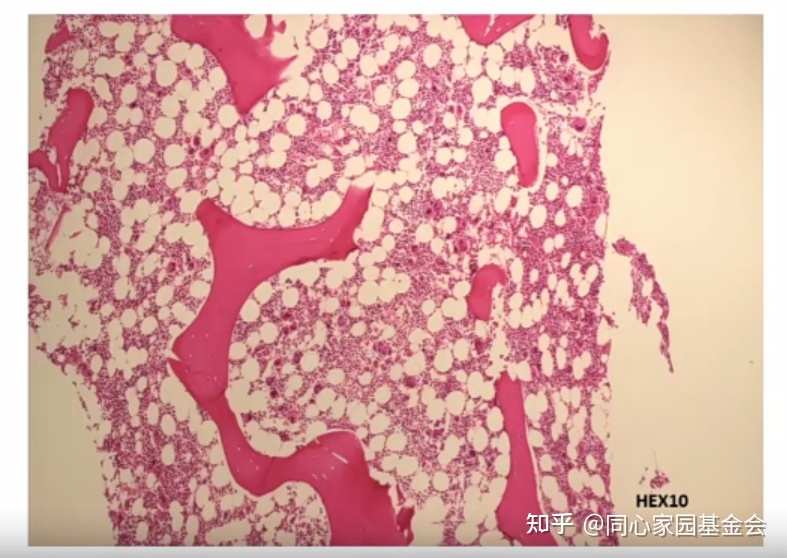专家讲座｜张培红教授：骨髓增殖性肿瘤（MPN）的病理展望