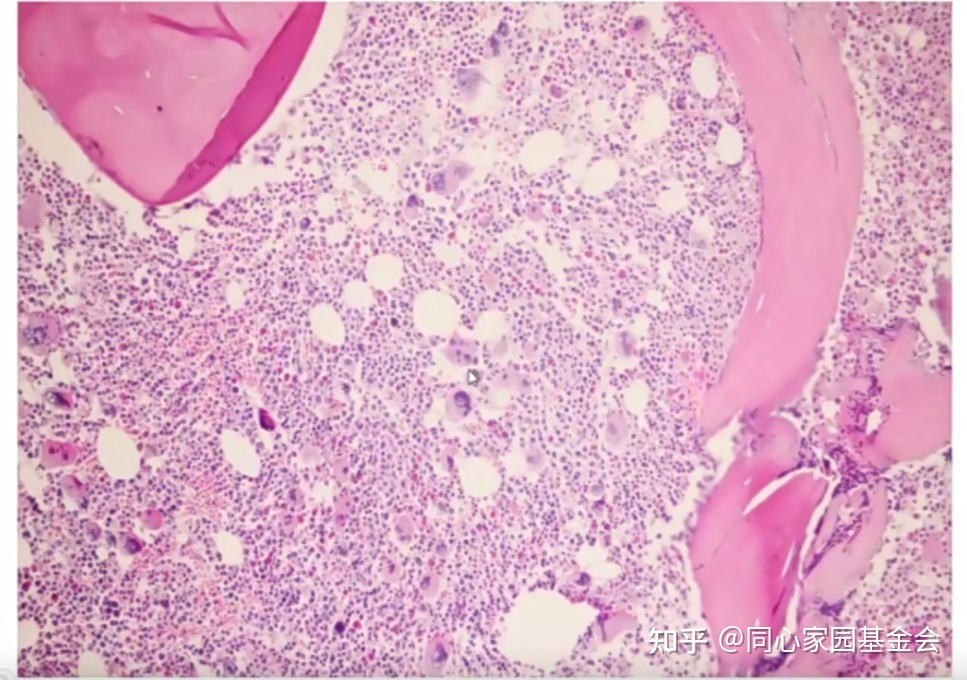 专家讲座｜张培红教授：骨髓增殖性肿瘤（MPN）的病理展望