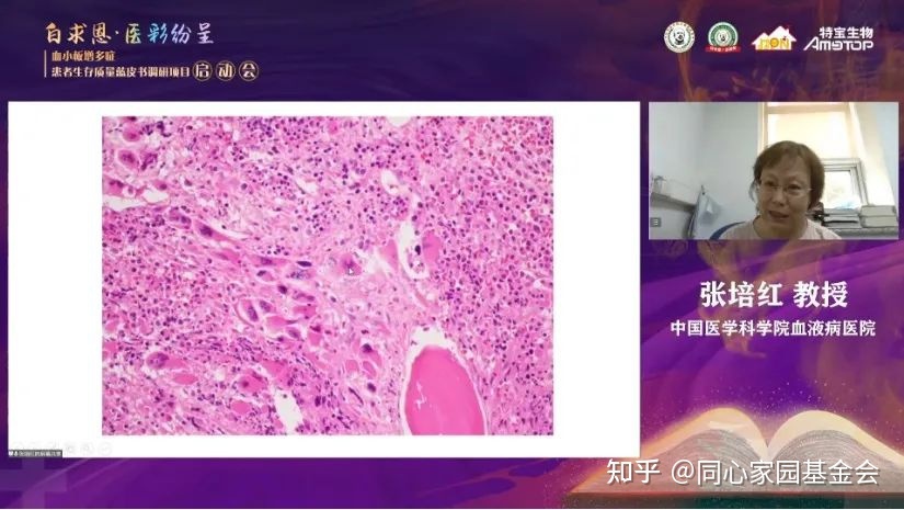 专家讲座｜张培红教授：骨髓增殖性肿瘤（MPN）的病理展望