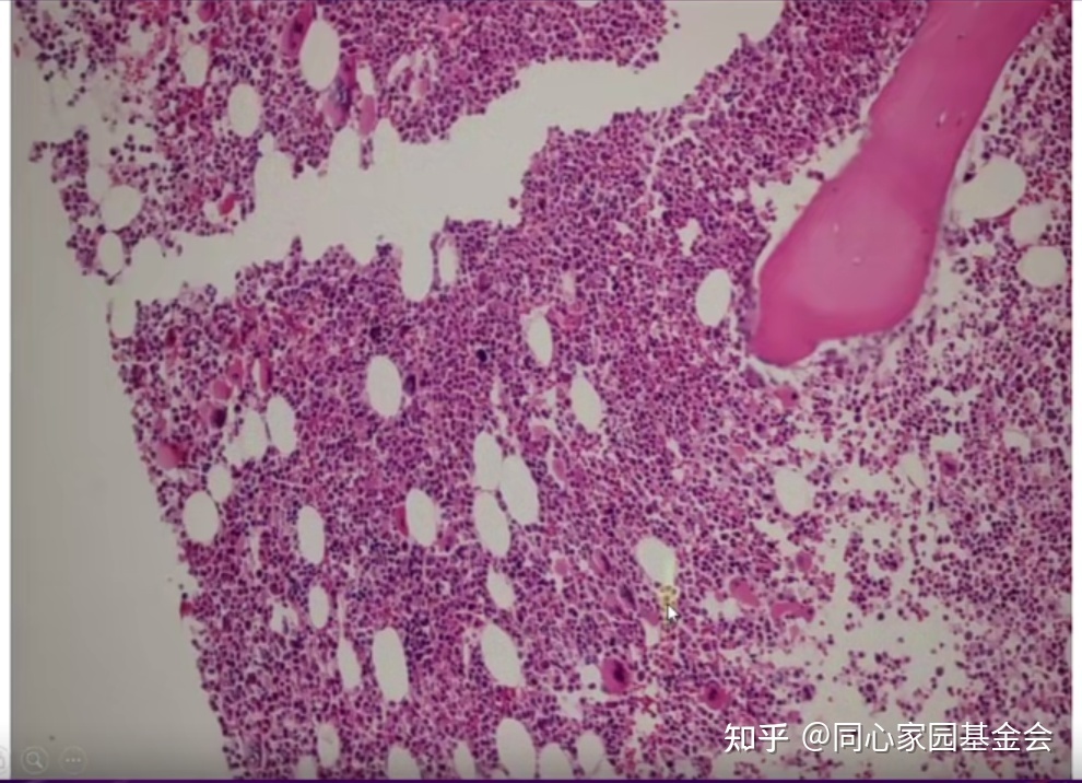 专家讲座｜张培红教授：骨髓增殖性肿瘤（MPN）的病理展望