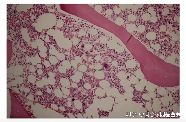 专家讲座｜张培红教授：骨髓增殖性肿瘤（MPN）的病理展望