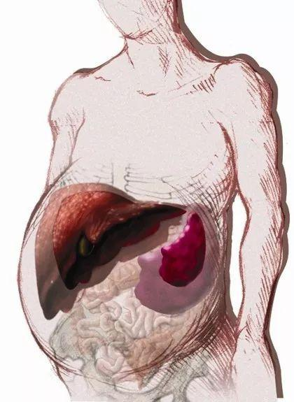 科普时间 | MPN患者，你的肝大了吗？