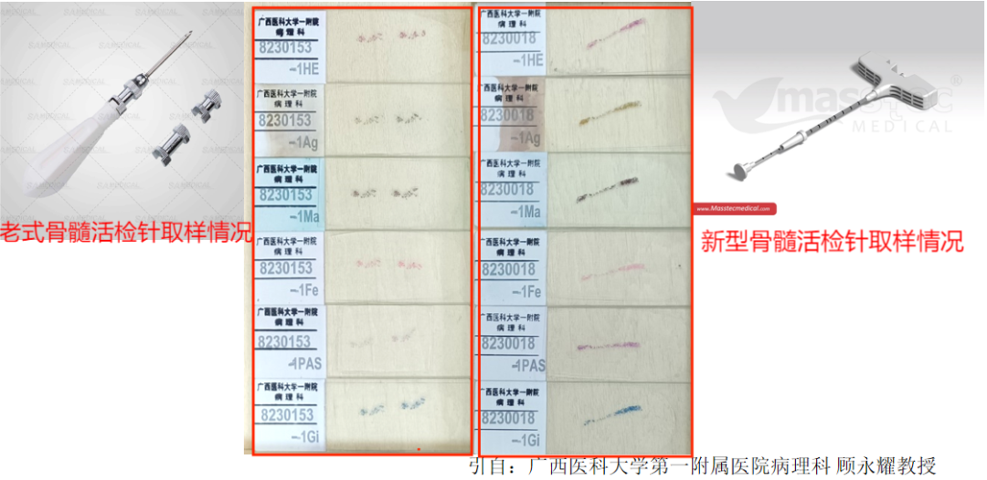 专家讲座｜段明辉教授：骨髓纤维化（PMF）诊断治疗进展