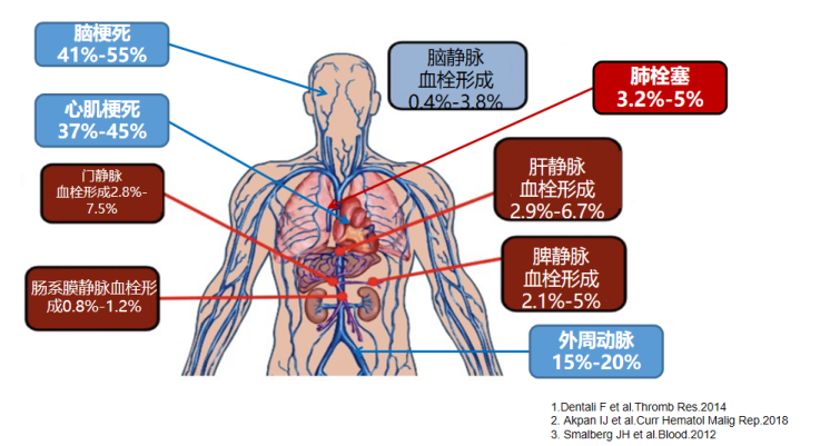 专家讲座丨黎承平教授解析MPN与血栓