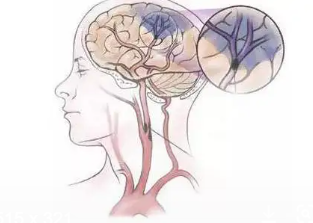 科普时间 | 干扰素对神经系统的影响